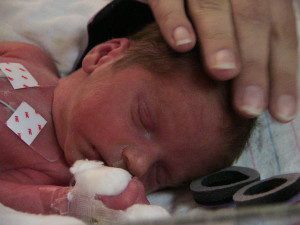 premature twin born at 31 weeks